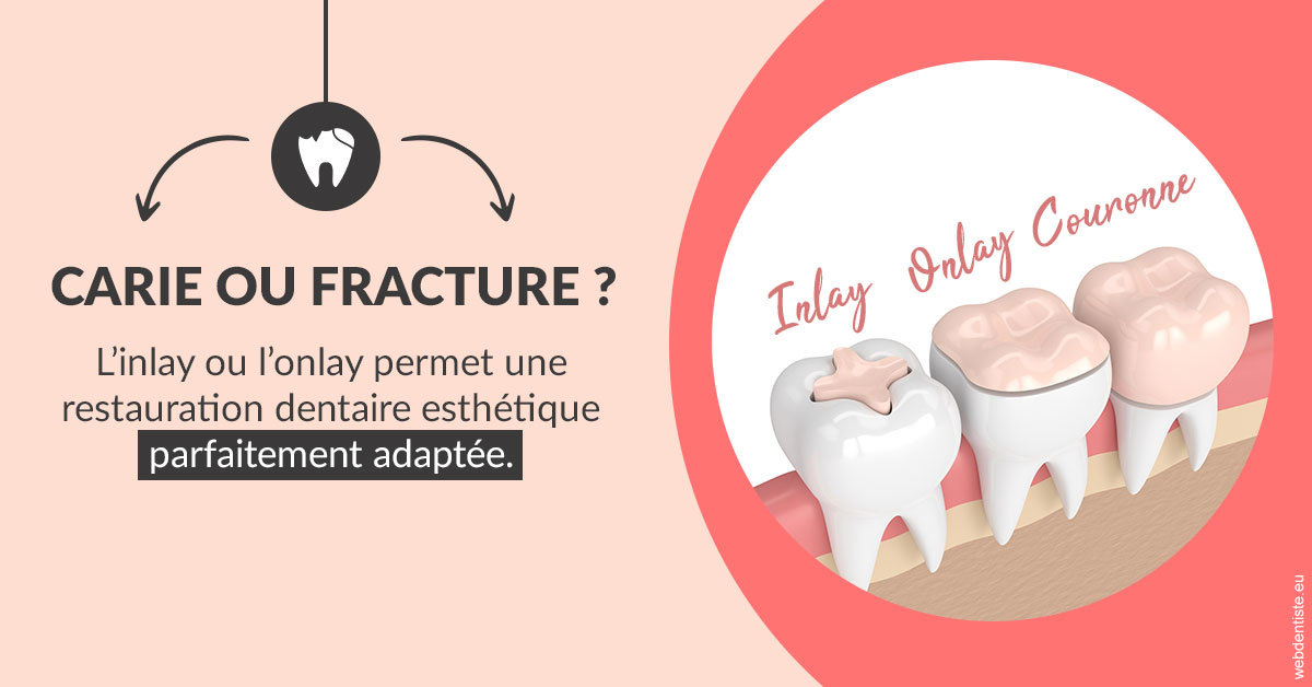 https://dr-masson-philippe.chirurgiens-dentistes.fr/T2 2023 - Carie ou fracture 2