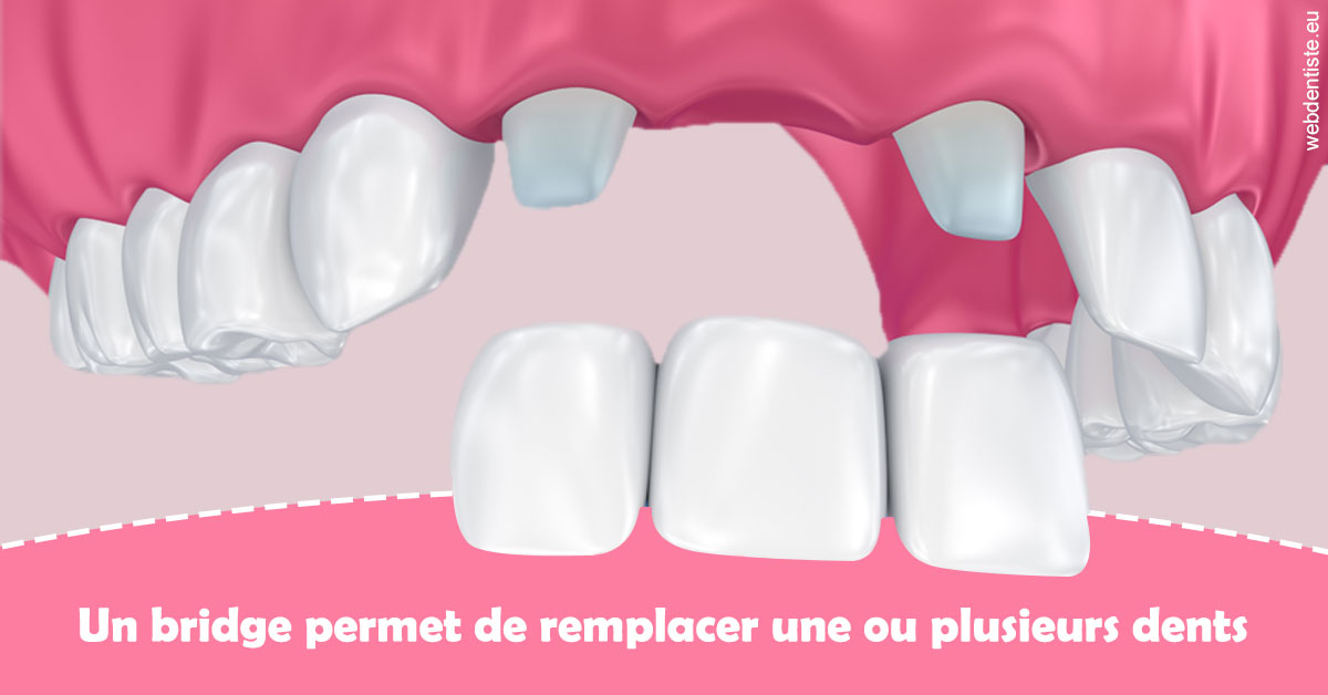 https://dr-masson-philippe.chirurgiens-dentistes.fr/Bridge remplacer dents 2
