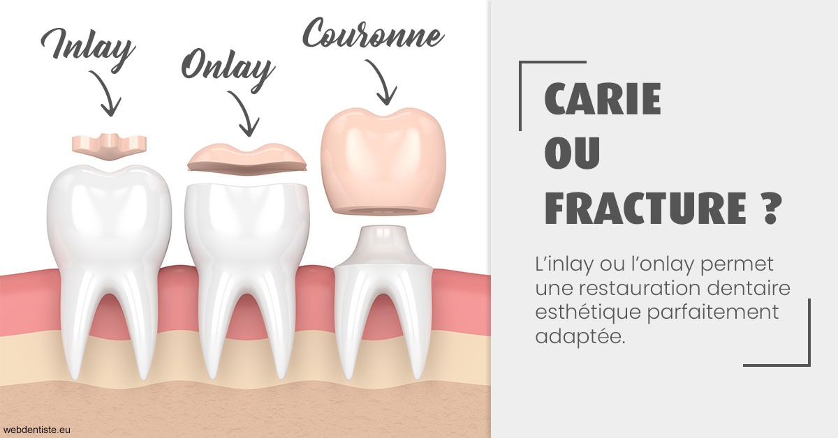 https://dr-masson-philippe.chirurgiens-dentistes.fr/T2 2023 - Carie ou fracture 1