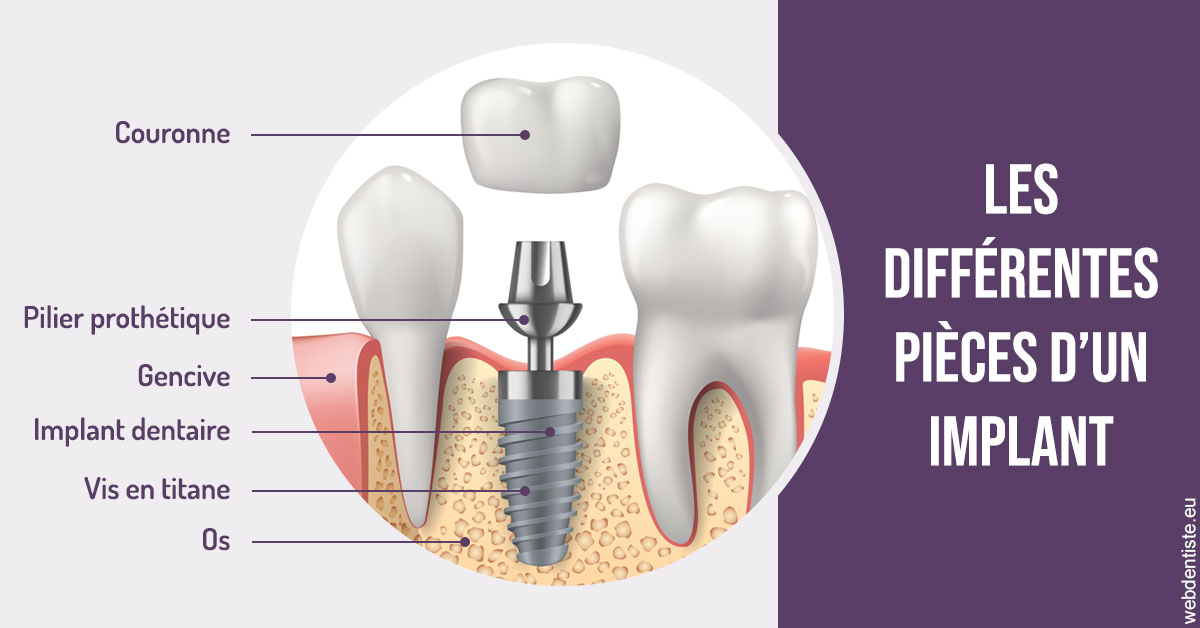 https://dr-masson-philippe.chirurgiens-dentistes.fr/Les différentes pièces d’un implant 2