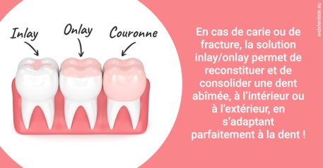 https://dr-masson-philippe.chirurgiens-dentistes.fr/L'INLAY ou l'ONLAY 2
