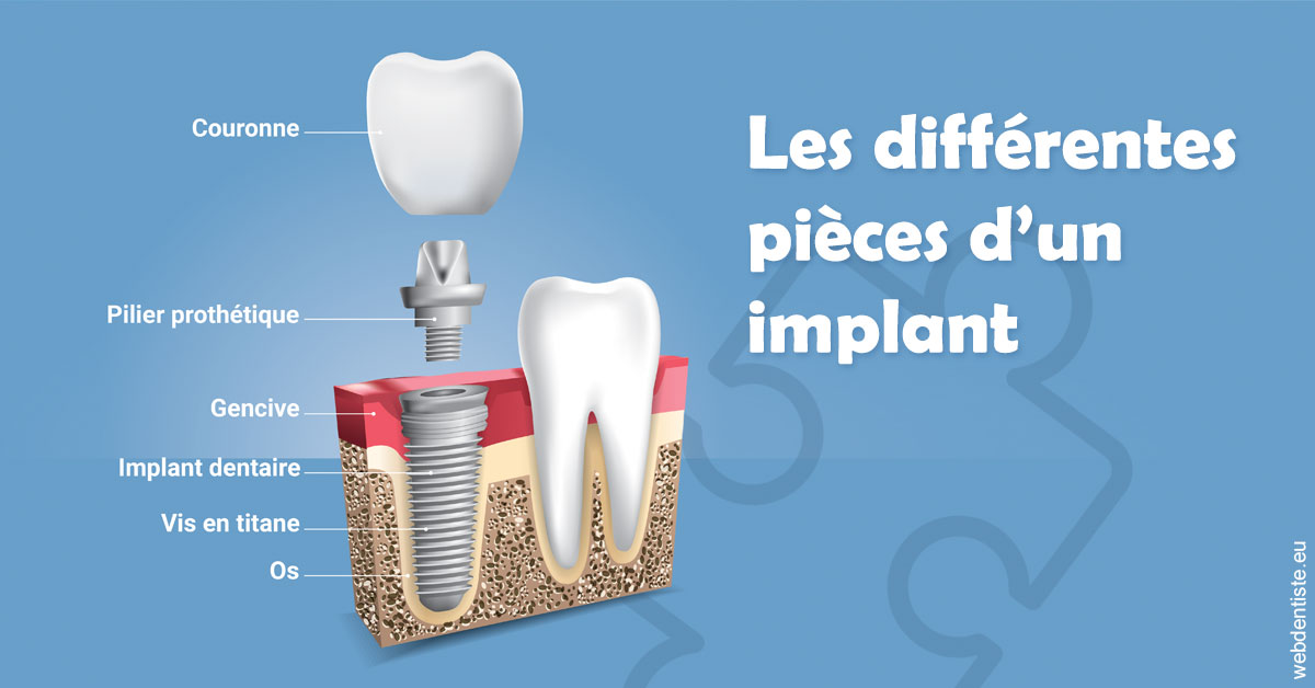 https://dr-masson-philippe.chirurgiens-dentistes.fr/Les différentes pièces d’un implant 1